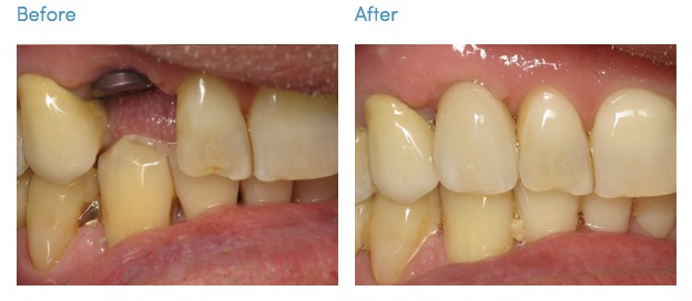 Implant Placement & Restorations South Bay