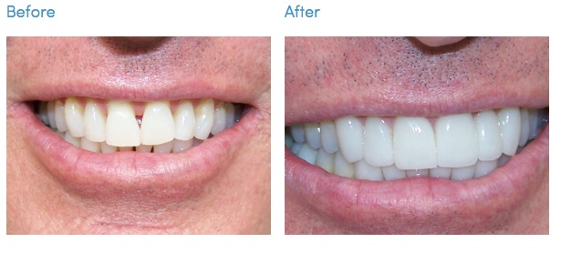 do veneers straighten teeth