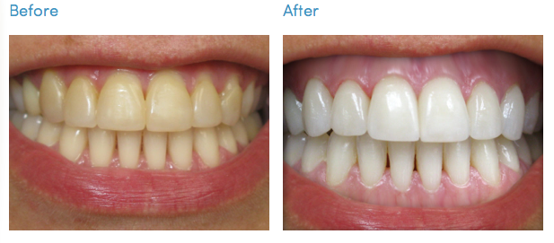 Advanced Dentistry Cosmetic Dentist Las Vegas | Teeth Whitening ...