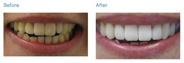 led teeth whitening before after