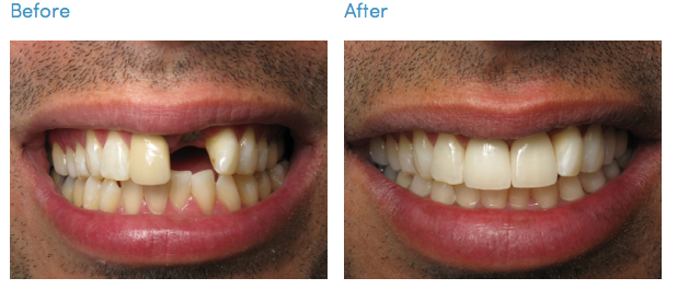 Implant Restorations Los Angeles