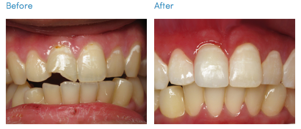 South Bay Porcelain Veneers