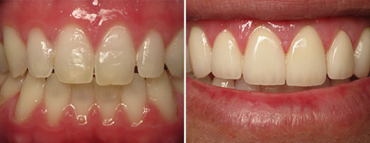 Before and after Veneers